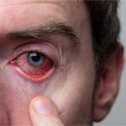 Close up of a man's really red eye as he deals with dry eyes